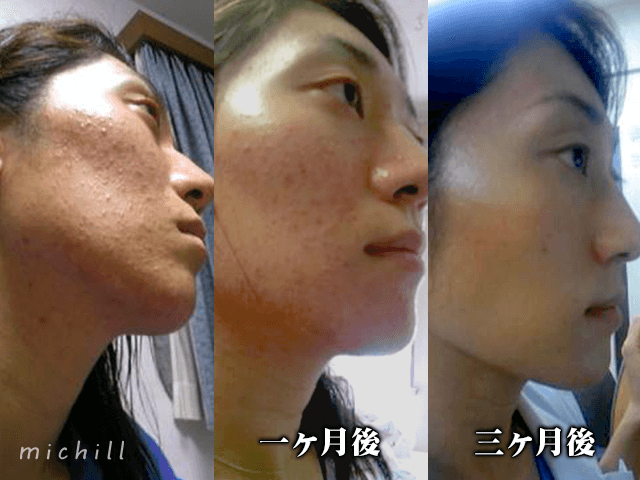 5分でできる 美容皮膚科医がすすめる炭酸美容の効果とは Michill ミチル