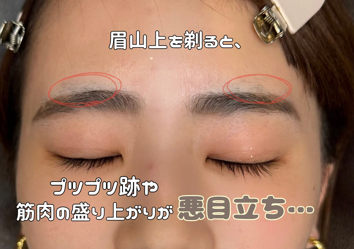 眉山の上側を剃った部分のプップツとした剃り跡や赤みのある状態 眉山の上側を剃った部分のプップツとした剃り跡や赤みのある状態